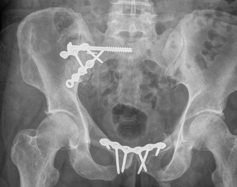 Pelvic Anterior Sacroiliac Plate 1